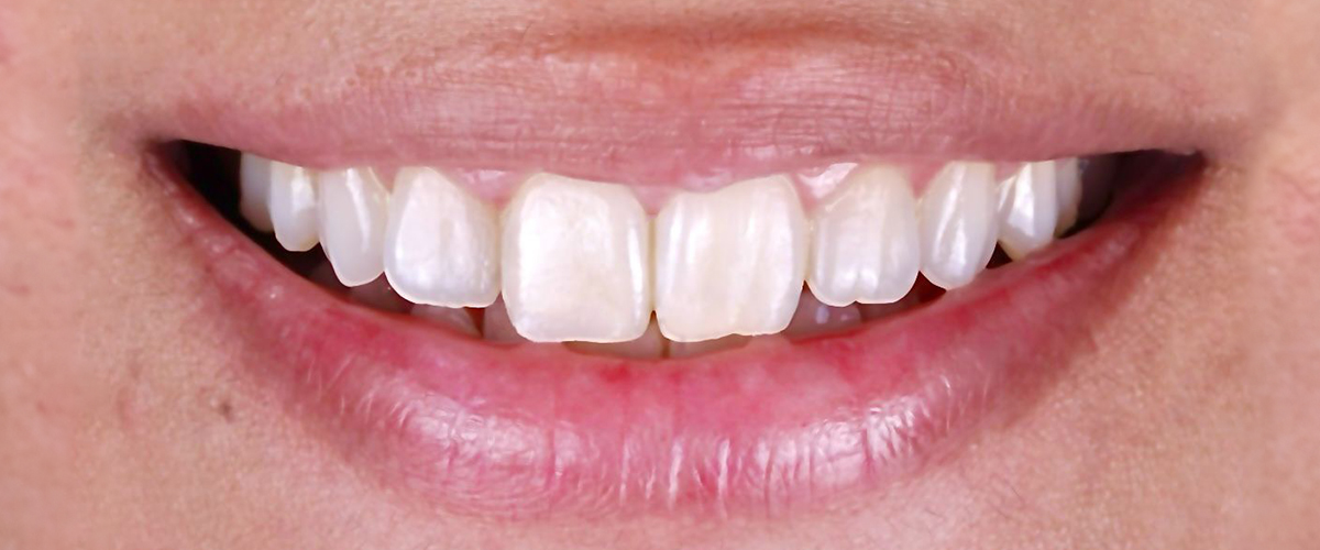 Painless Perfection With Non-Surgical Dental Procedures For A Stunning Smile