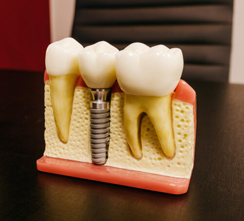 dental implant