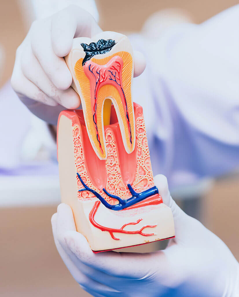 Need For Root Canal Treatment Near Me