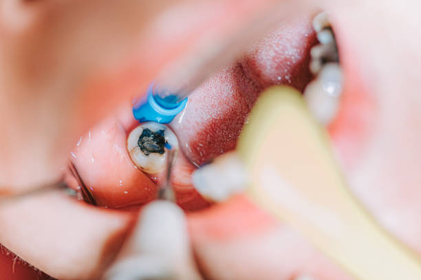 Cost Of Root Canal In Bandra Mumbai