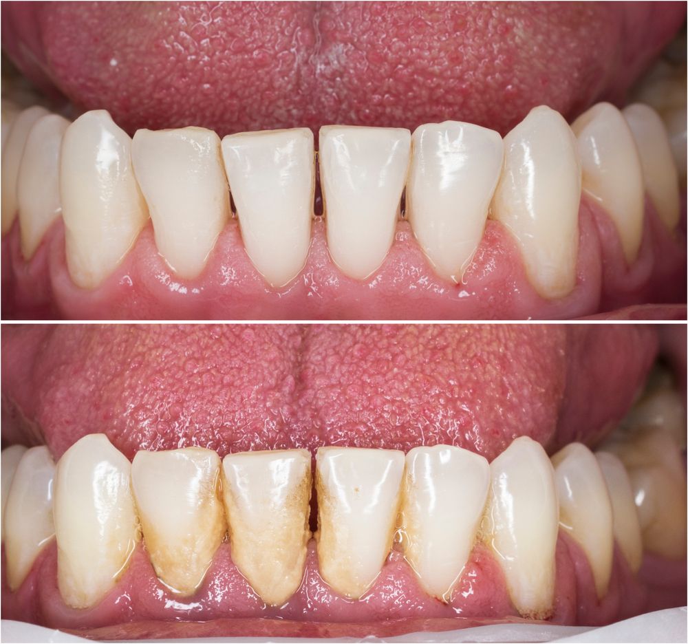 TEETH CLEANING BEFORE AND AFTER